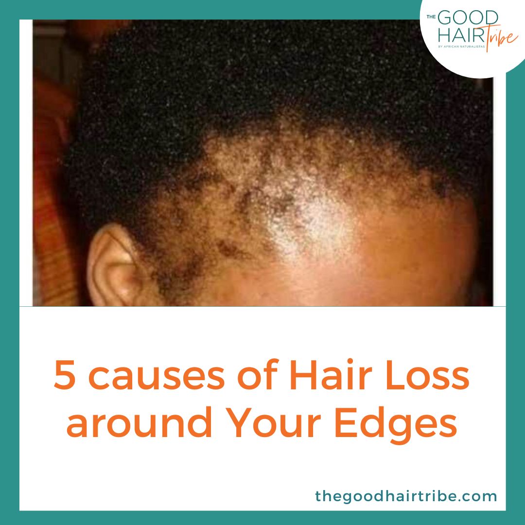 5 causes of Hair Loss around Your Edges