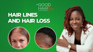 Hair Lines and Hair Loss